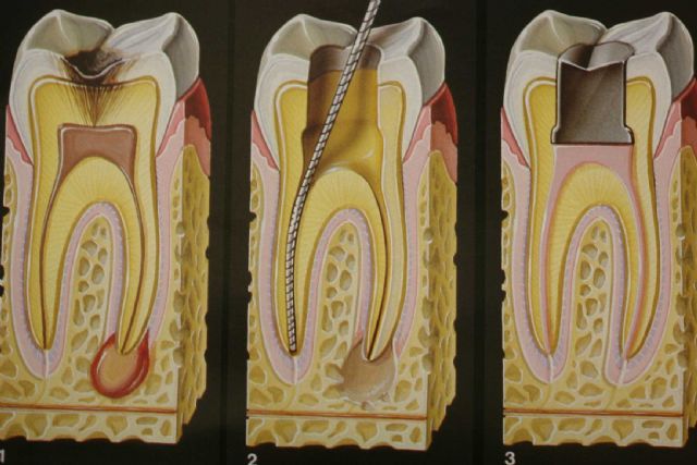 Endodonti (Kanal Tedavisi)